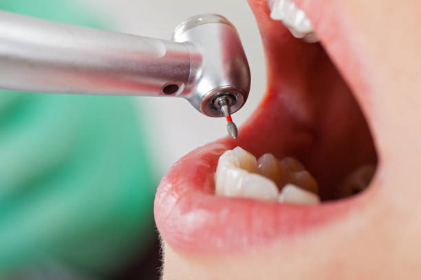 Best Lost Filling or Crown Replacement in Glassboro, NJ